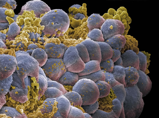 Breast cancer cells